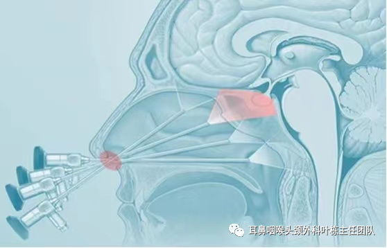 操作鼻窦镜时怎么摆术后指南：鼻内镜下鼻窦炎术后注意事项及护理要点_https://www.jmylbn.com_新闻资讯_第4张