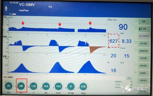 呼吸机f指什么呼吸机名词解释（三）_https://www.jmylbn.com_新闻资讯_第1张