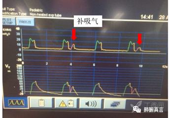 呼吸机f指什么呼吸机名词解释（三）_https://www.jmylbn.com_新闻资讯_第26张