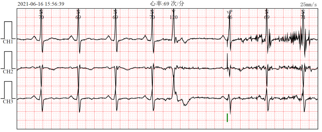 心电图器怎么用【今日心血管病例练习】复杂的双腔起搏器心电图鉴别诊断_https://www.jmylbn.com_新闻资讯_第2张