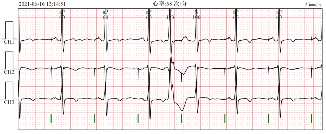 心电图器怎么用【今日心血管病例练习】复杂的双腔起搏器心电图鉴别诊断_https://www.jmylbn.com_新闻资讯_第3张