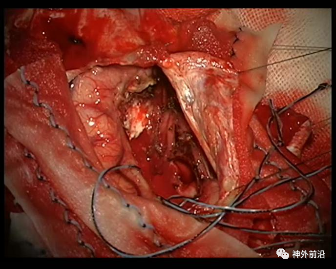 神刀博览天坛医院王磊累及双侧额叶巨大胶质瘤手术如何寻找边界和保护