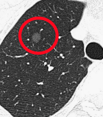 体检dr是什么意思【科普】 肺部体检选择摄片（DR）还是CT？_https://www.jmylbn.com_新闻资讯_第9张