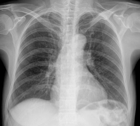 体检dr是什么意思【科普】 肺部体检选择摄片（DR）还是CT？_https://www.jmylbn.com_新闻资讯_第6张