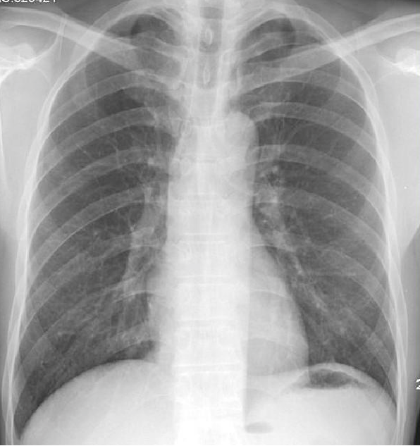 体检dr是什么意思【科普】 肺部体检选择摄片（DR）还是CT？_https://www.jmylbn.com_新闻资讯_第8张