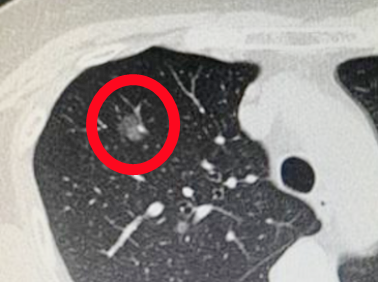 体检dr是什么意思【科普】 肺部体检选择摄片（DR）还是CT？_https://www.jmylbn.com_新闻资讯_第7张