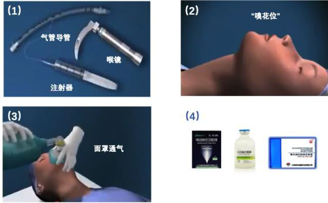 呼吸面罩是怎么充气【急救】新冠感染危重患者气管插管术_https://www.jmylbn.com_新闻资讯_第7张