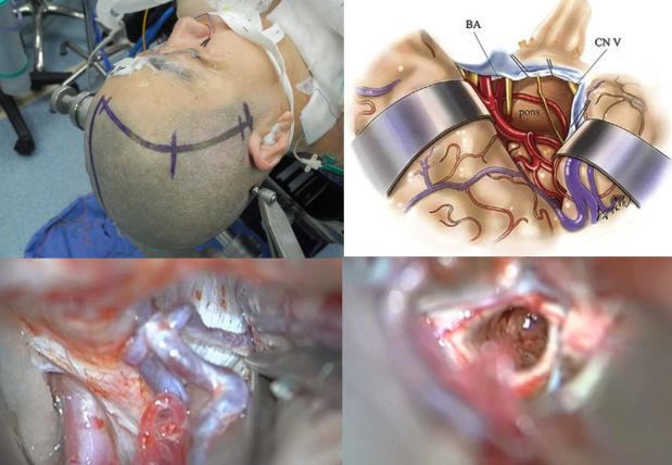 瘤手術體位個性化選擇聽神經瘤手術體位及入路顱底疾病全覆蓋精研前行