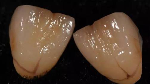 为什么医生总是推荐做全瓷牙？