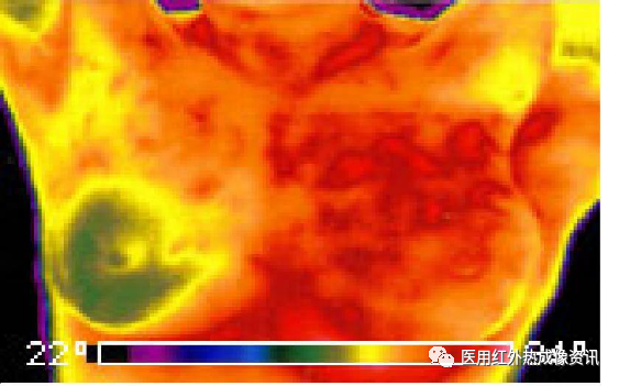 医用红外热像仪怎么开机【健康科普】热像仪医疗应用_https://www.jmylbn.com_新闻资讯_第3张