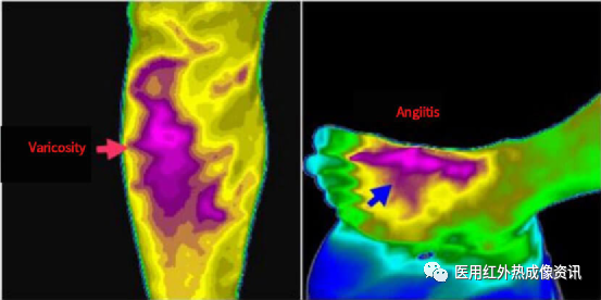 医用红外热像仪怎么开机【健康科普】热像仪医疗应用_https://www.jmylbn.com_新闻资讯_第4张