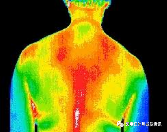 医用红外热像仪怎么开机【健康科普】热像仪医疗应用_https://www.jmylbn.com_新闻资讯_第6张