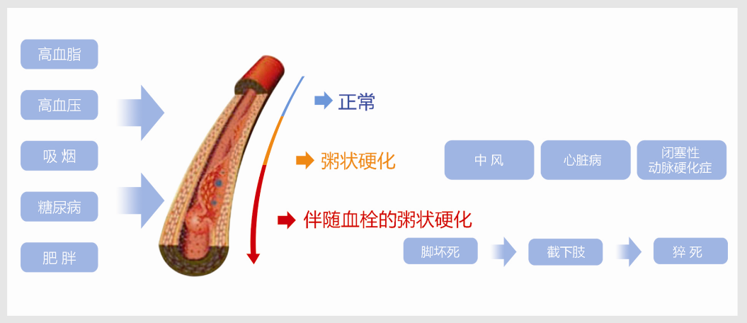 动脉硬化怎么检测血管“照妖镜”——动脉硬化检测_https://www.jmylbn.com_新闻资讯_第2张