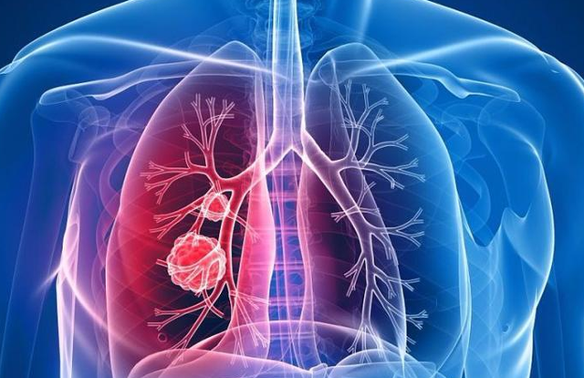 肺部结节 肺部结节