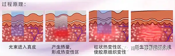 点阵激光后冷敷怎么敷【再添利器】烧伤与创面修复科引进“皮肤的橡皮擦”——二氧化碳点阵激光仪_https://www.jmylbn.com_新闻资讯_第7张