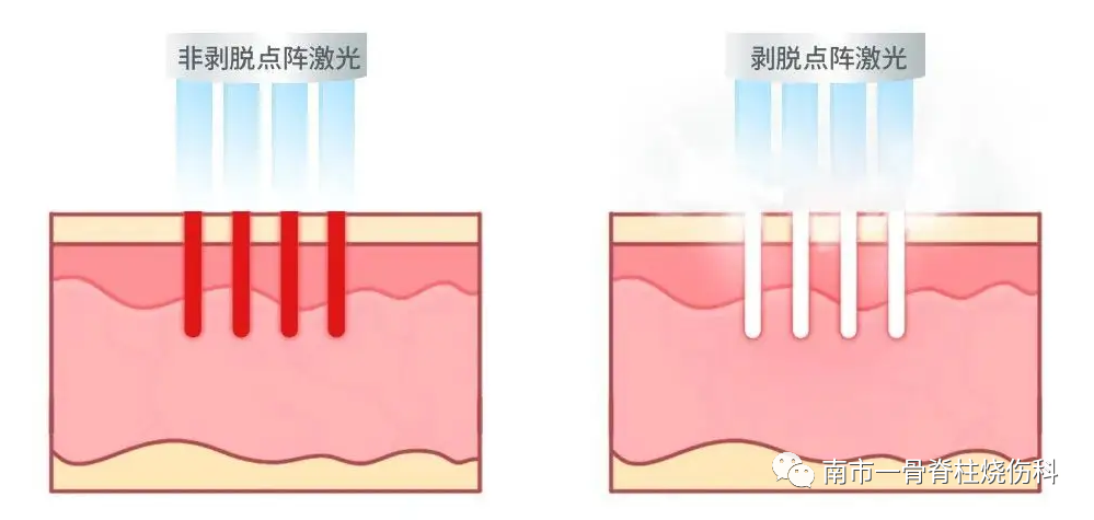 点阵激光后冷敷怎么敷【再添利器】烧伤与创面修复科引进“皮肤的橡皮擦”——二氧化碳点阵激光仪_https://www.jmylbn.com_新闻资讯_第8张