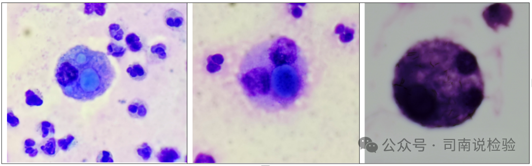 尿沉渣仪器怎么使用尿液-吞噬细胞（仪器辅助诊断）_https://www.jmylbn.com_新闻资讯_第10张
