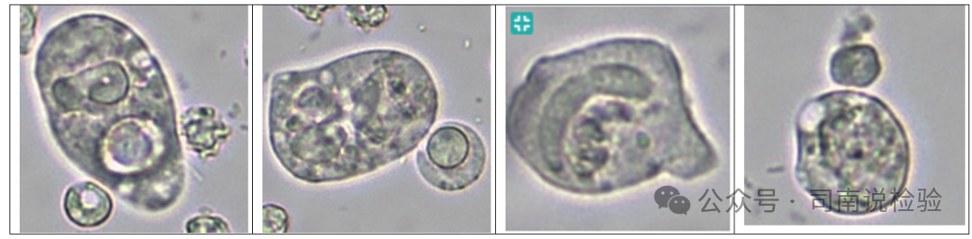 尿沉渣仪器怎么使用尿液-吞噬细胞（仪器辅助诊断）_https://www.jmylbn.com_新闻资讯_第4张