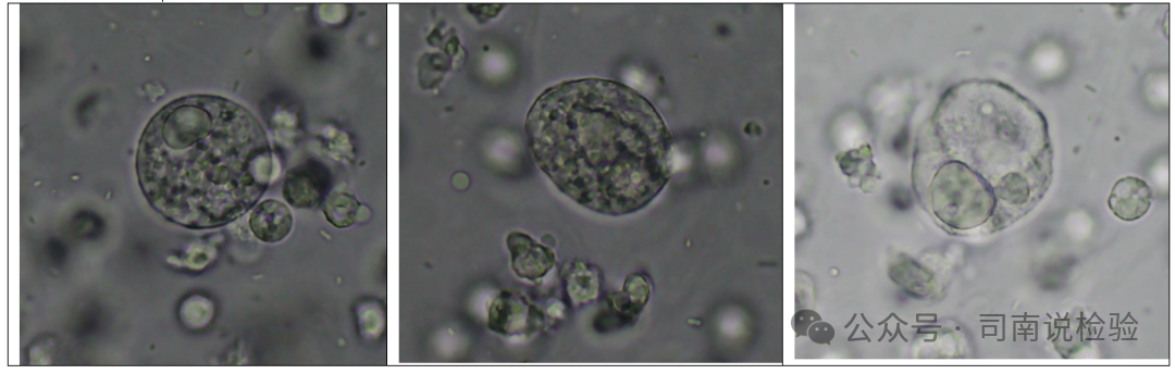 尿沉渣仪器怎么使用尿液-吞噬细胞（仪器辅助诊断）_https://www.jmylbn.com_新闻资讯_第5张