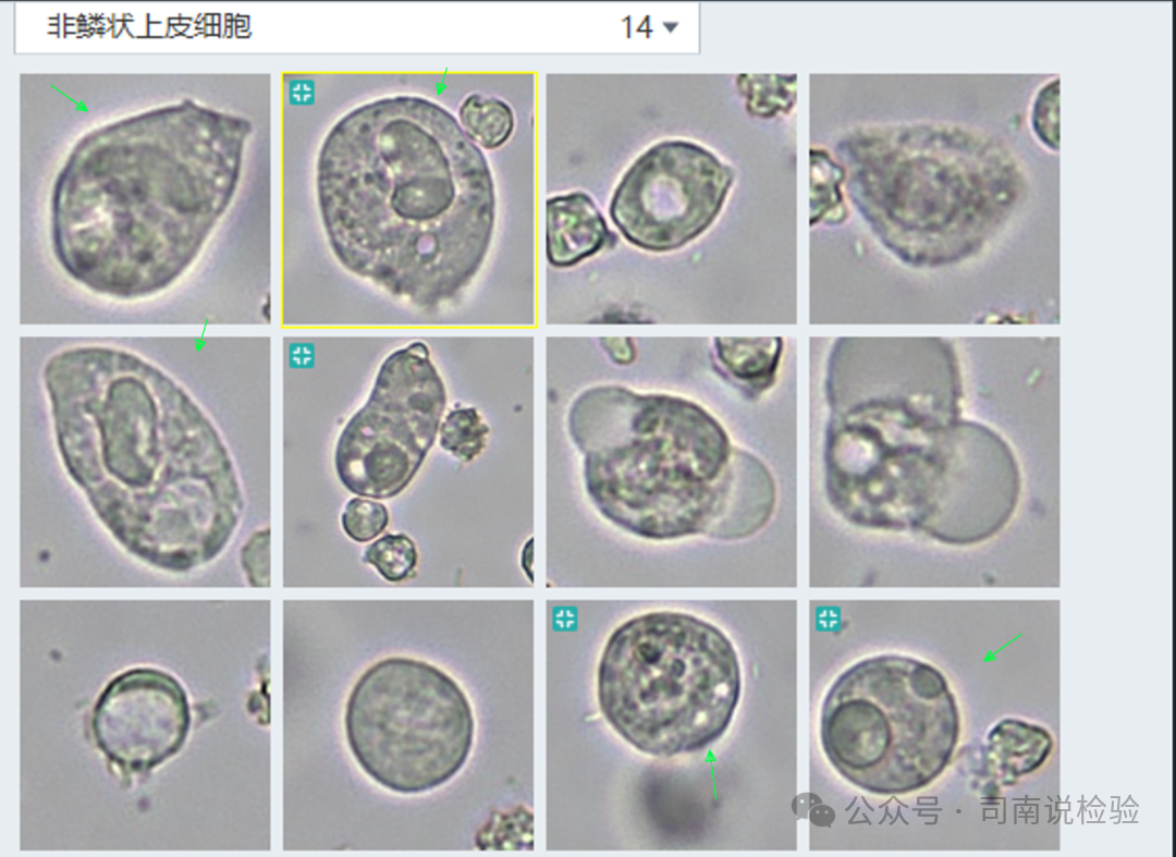 尿沉渣仪器怎么使用尿液-吞噬细胞（仪器辅助诊断）_https://www.jmylbn.com_新闻资讯_第3张