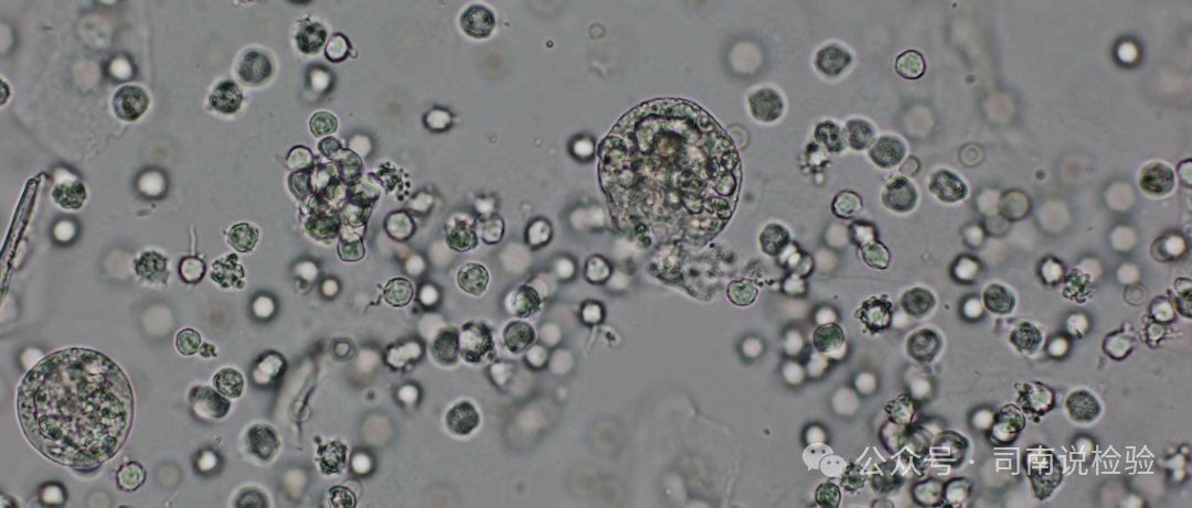 尿沉渣仪器怎么使用尿液-吞噬细胞（仪器辅助诊断）_https://www.jmylbn.com_新闻资讯_第13张