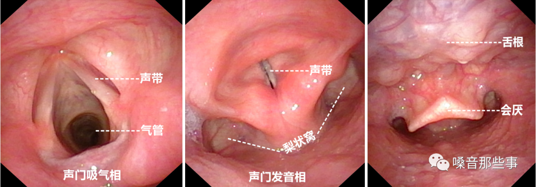 为什么购买可视硬性喉镜临床常见喉镜的分类及使用_https://www.jmylbn.com_新闻资讯_第13张