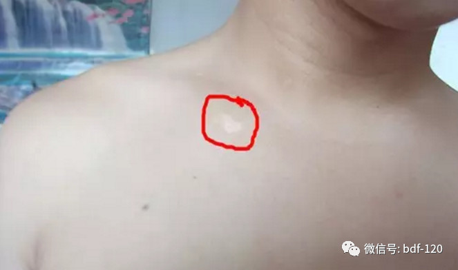 白癜风的早期症状图片