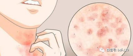 警惕！白癜风白斑皮肤易过敏，妙招防过敏赶紧学起来……