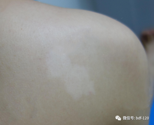 【反馈】背部白癜风治疗对比图，这样的效果我很满意！