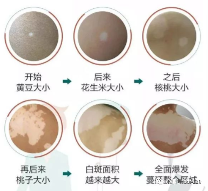 “一拖再拖”的白癜风最终会变成什么样子？