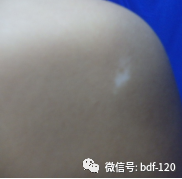 白癜风能自愈？教你5招唤醒白斑的“自愈”能力！