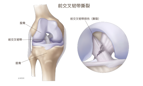 医学上ACL是什么前交叉韧带（ACL）修复术丨医学英语视听学习_https://www.jmylbn.com_新闻资讯_第2张
