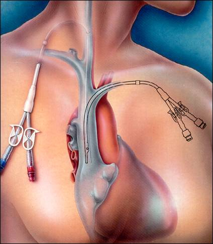 中心导管怎么使用漫语健康 ｜ 透析用中心静脉导管的使用和维护_https://www.jmylbn.com_新闻资讯_第3张