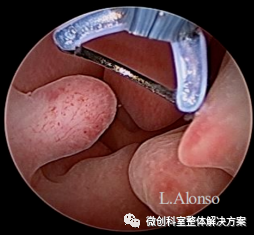 什么是膨宫液宫腔镜操作技巧大全：时间选择、膨宫液选择、出血防治……-上海聚慕医疗器械有限公司
