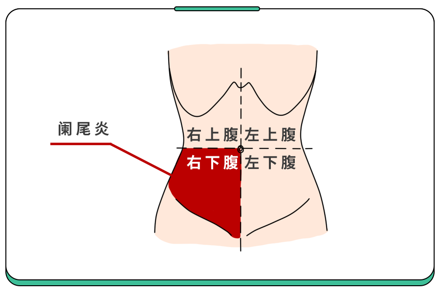 如果孩子指的是右下腹,那就有可能是:这种肚子痛要马上去医院急诊!