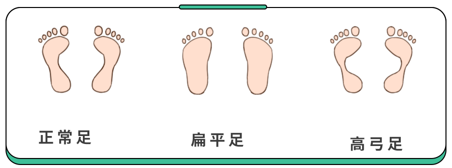 属于遗传性扁平足5,如果两种姿态下踩出的脚印相差不大,都出现扁平足