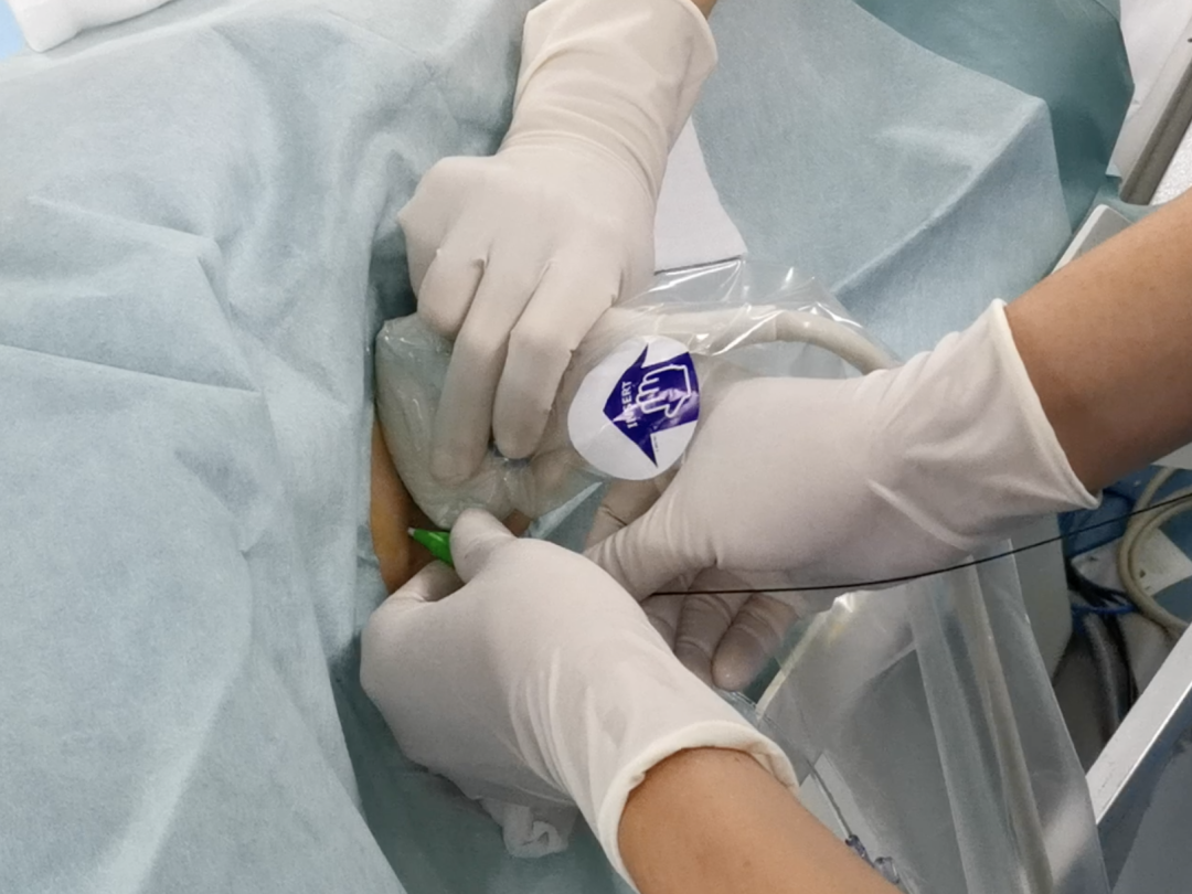 ptc针是什么针【优秀病例】超声引导下经皮经肝门静脉穿刺术为门静脉系统血栓治疗“狭道开路”_https://www.jmylbn.com_新闻资讯_第2张