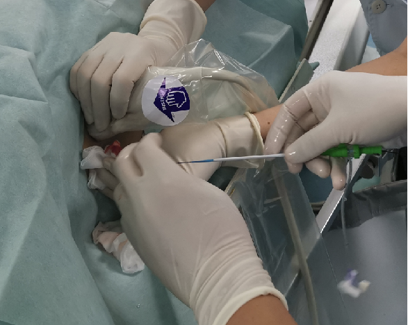 ptc针是什么针【优秀病例】超声引导下经皮经肝门静脉穿刺术为门静脉系统血栓治疗“狭道开路”_https://www.jmylbn.com_新闻资讯_第1张