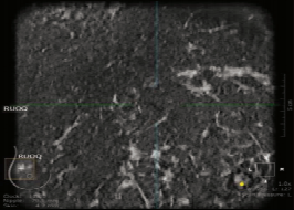 什么是超声容积探头【解读】自动乳腺容积超声技术专家共识 (2022 版)_https://www.jmylbn.com_新闻资讯_第10张