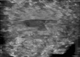 什么是超声容积探头【解读】自动乳腺容积超声技术专家共识 (2022 版)_https://www.jmylbn.com_新闻资讯_第14张