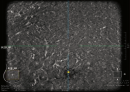 什么是超声容积探头【解读】自动乳腺容积超声技术专家共识 (2022 版)_https://www.jmylbn.com_新闻资讯_第8张
