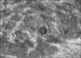 什么是超声容积探头【解读】自动乳腺容积超声技术专家共识 (2022 版)_https://www.jmylbn.com_新闻资讯_第16张