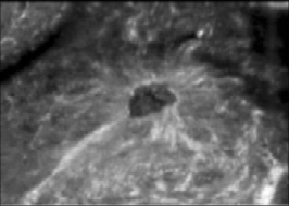 什么是超声容积探头【解读】自动乳腺容积超声技术专家共识 (2022 版)_https://www.jmylbn.com_新闻资讯_第15张