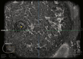 什么是超声容积探头【解读】自动乳腺容积超声技术专家共识 (2022 版)_https://www.jmylbn.com_新闻资讯_第7张