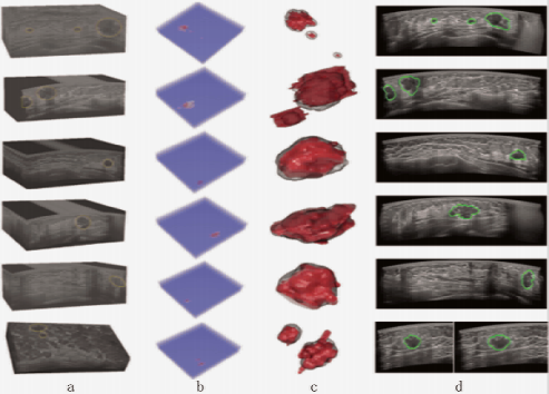 什么是超声容积探头【解读】自动乳腺容积超声技术专家共识 (2022 版)_https://www.jmylbn.com_新闻资讯_第28张