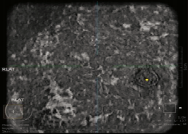 什么是超声容积探头【解读】自动乳腺容积超声技术专家共识 (2022 版)_https://www.jmylbn.com_新闻资讯_第6张