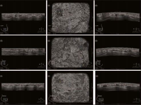 什么是超声容积探头【解读】自动乳腺容积超声技术专家共识 (2022 版)_https://www.jmylbn.com_新闻资讯_第26张