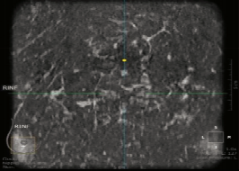 什么是超声容积探头【解读】自动乳腺容积超声技术专家共识 (2022 版)_https://www.jmylbn.com_新闻资讯_第9张