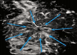 什么是超声容积探头【解读】自动乳腺容积超声技术专家共识 (2022 版)_https://www.jmylbn.com_新闻资讯_第13张