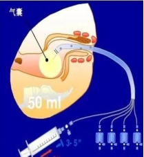 消化道动力检测怎么做医院动态 ｜ 便秘患者的福音来了！我院肛肠外科开展DJ-S8CT 型消化道动力检测（直肠测压）和盆底生物反馈治疗业务_https://www.jmylbn.com_新闻资讯_第6张